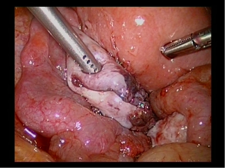 Left Ovary after Shelling off Endometriotic  Ovarian Cyst